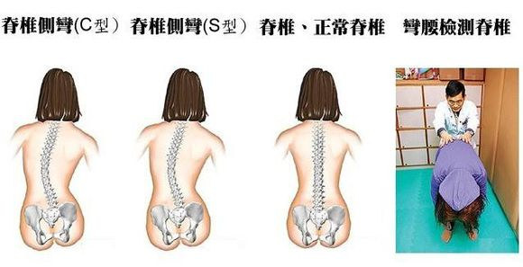 先天性脊柱侧凸的相关病症